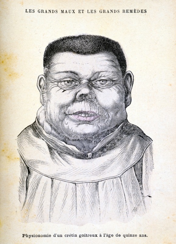 Cretin aged 15