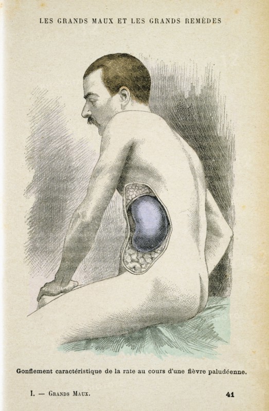 Typical enlarged spleen of a Malaria patient