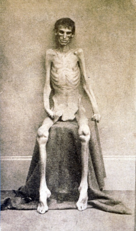 A Federal prisoner, returned from prison American Civil War c 1865