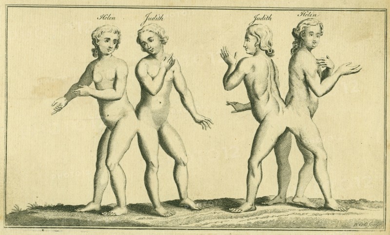 Siamese or conjoined twins