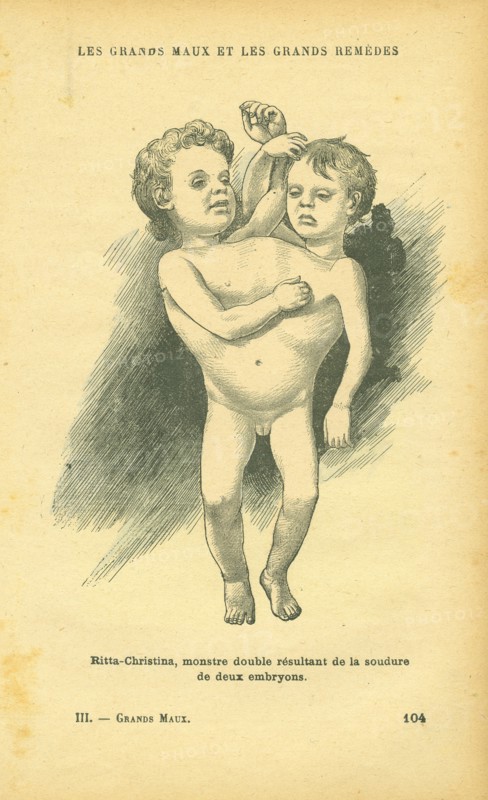 Siamese or conjoined twins
