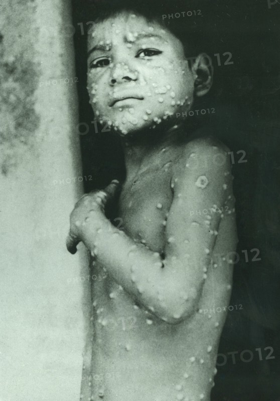 Last indigenous case of Smallpox in India, Katihar District, Eihar State