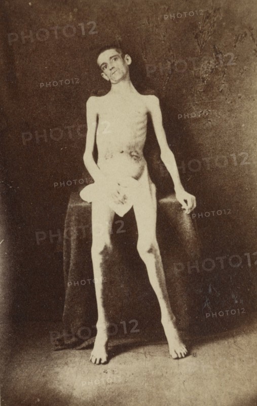 Returned Federal prisoner from Andersonville prison, 1864