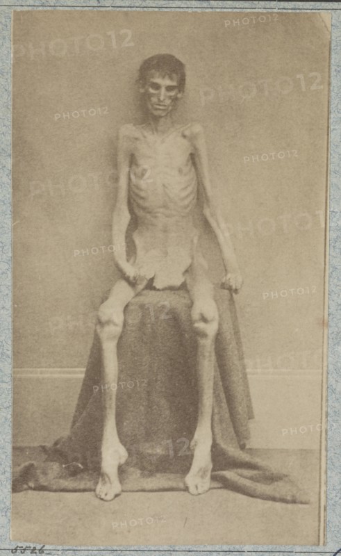Returned Federal prisoner from Andersonville prison, 1864