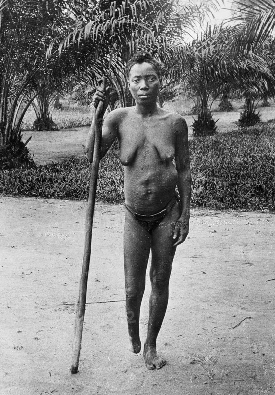 Amputation in the Congo Free State