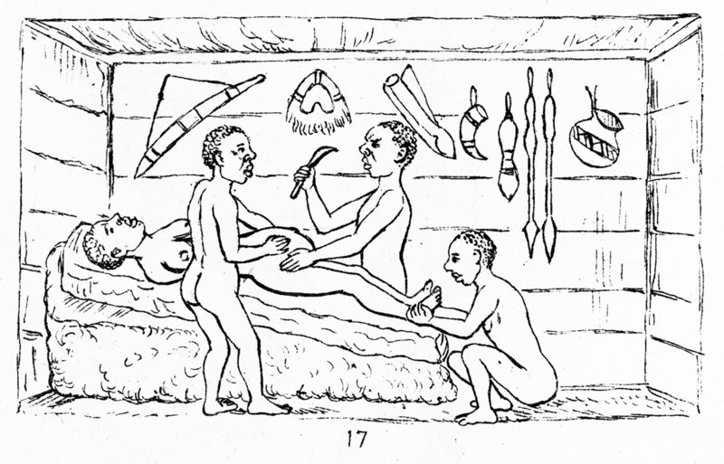 Line drawing of a Cesarean