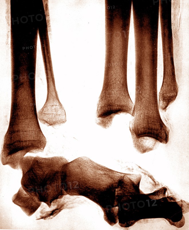 X-ray images of the legs of an ancient Egyptian mummy created soon after the announcement of Wilhelm Röntgen's discovery of X-rays