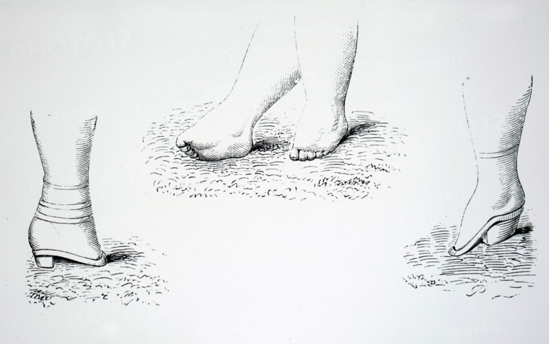 Damaged feet caused by foot binding in China