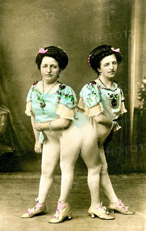 The Siamese twins Josefa and Rosa Blazek