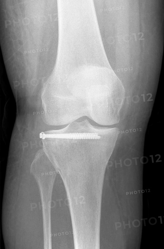 X-ray of a patient after tibial plateau fracture with 2 screws