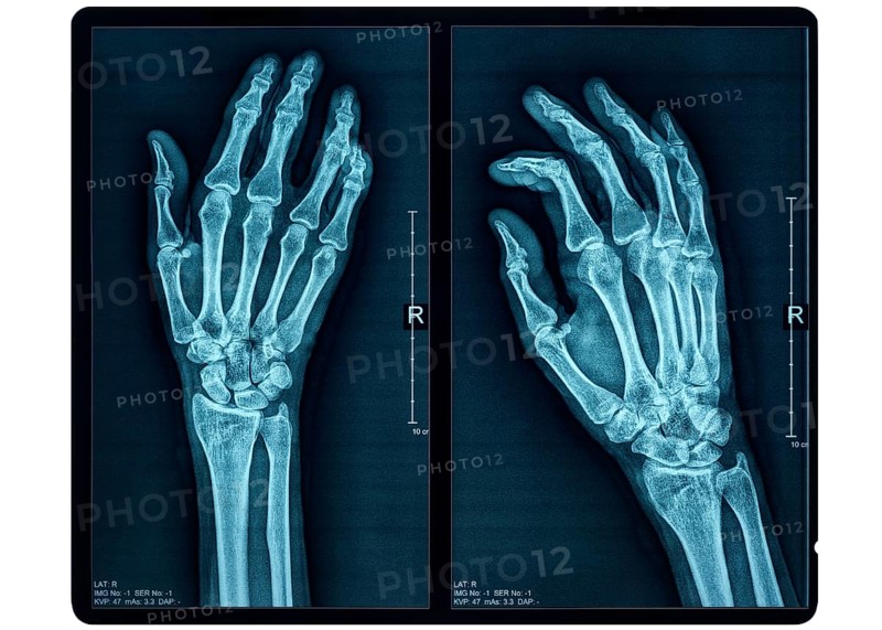 Hand X-ray of an adult female