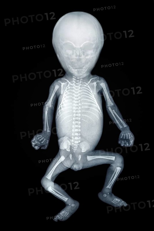 X-ray of a baby