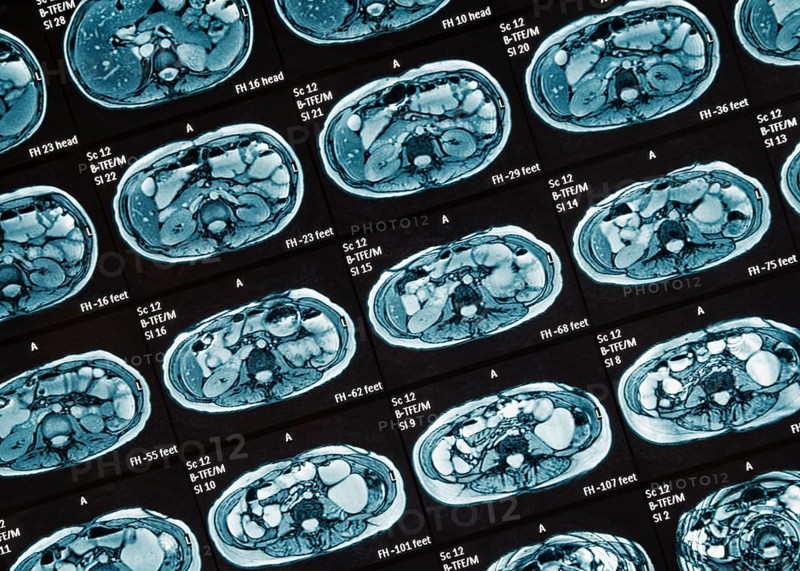 MRI scan