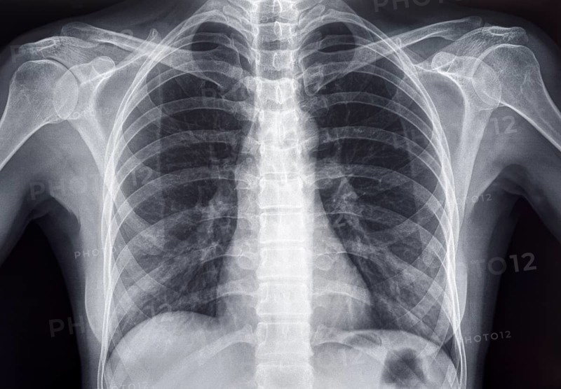 Chest x-ray of an adult female human