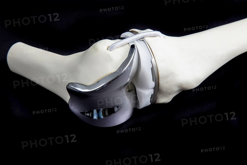 Knee prosthesis