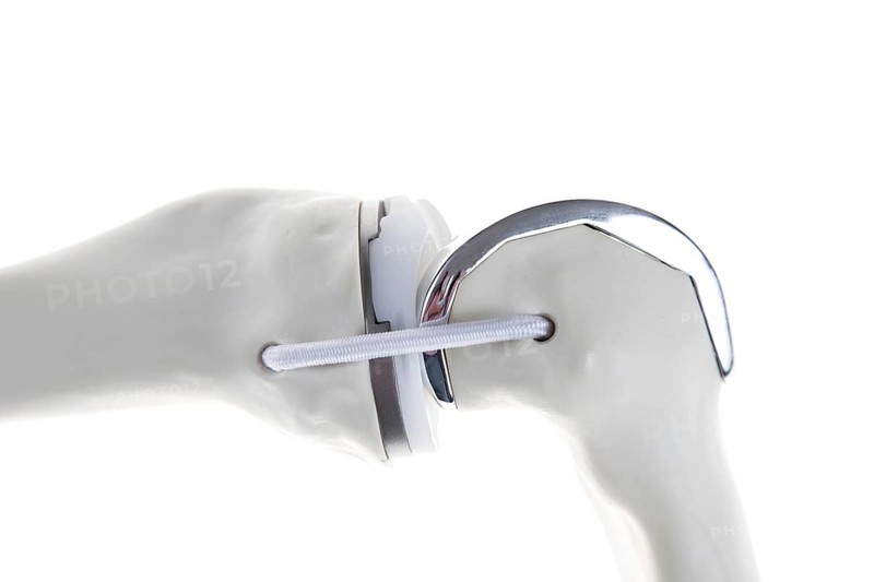 Knee prosthesis