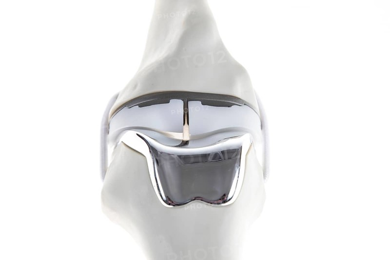 Knee prosthesis