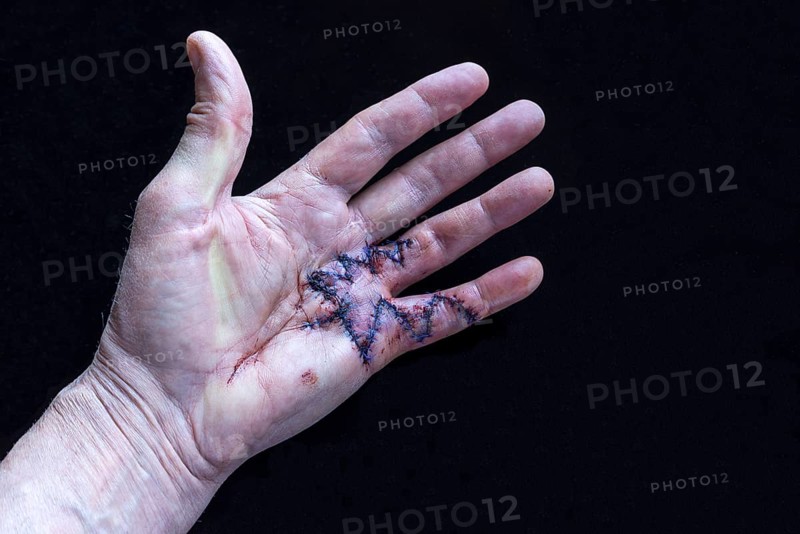 Fresh surgical sutures of a Duypuytren's contracture on the small and ring finger of the left hand