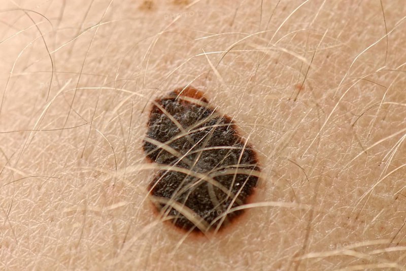 Malignant melanoma
