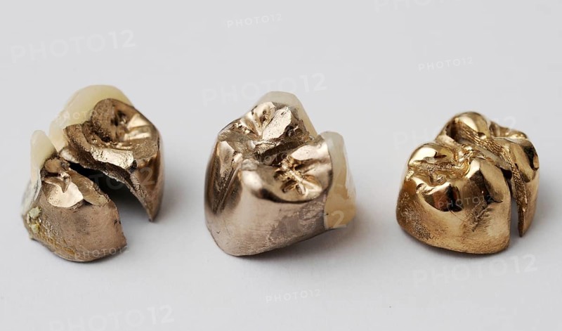 Dental gold