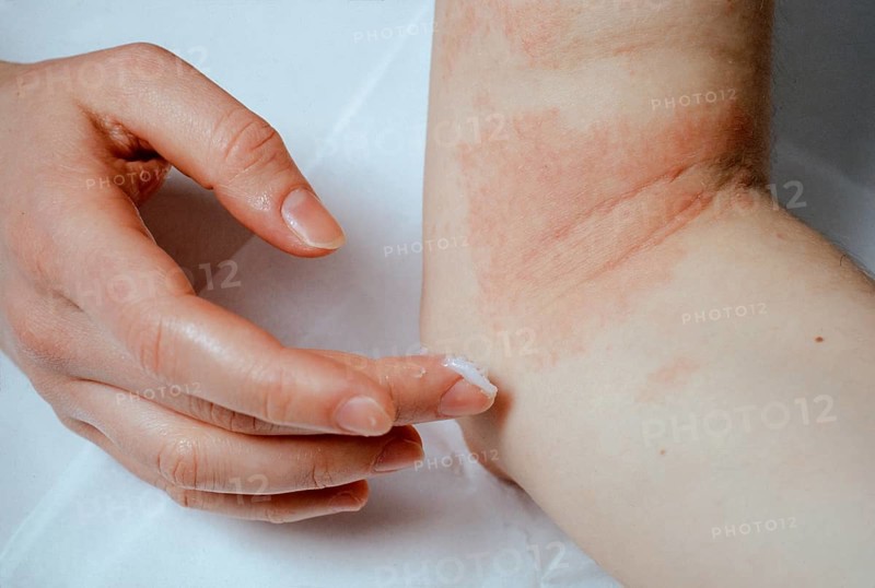 Woman applying ointment to eczema at the elbow