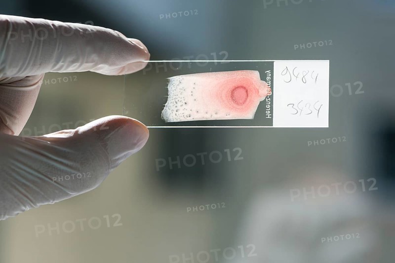 Blood smeared on a glass slide for diagnosis