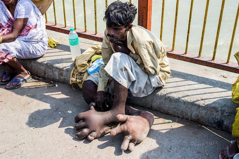 A beggar with Elephantiasis at his feet is sitting at Harki Pauri Ghat at the holy river Ganges