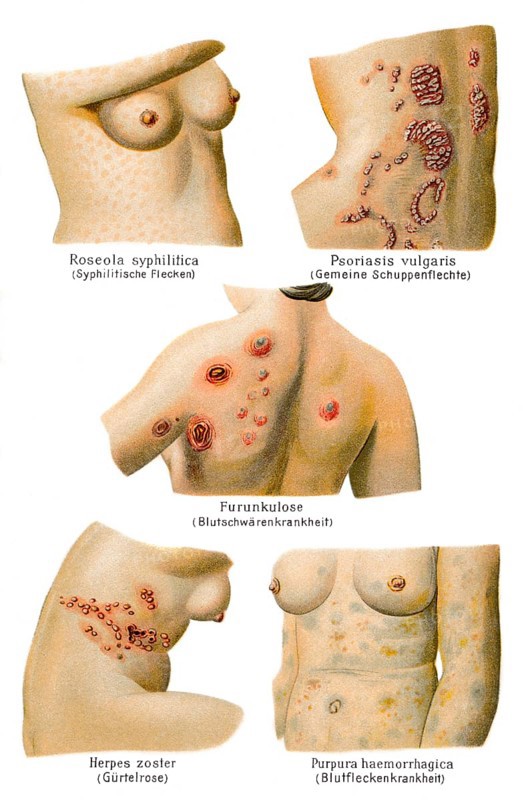 Skin diseases