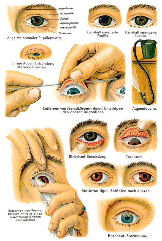 Various eye diseases