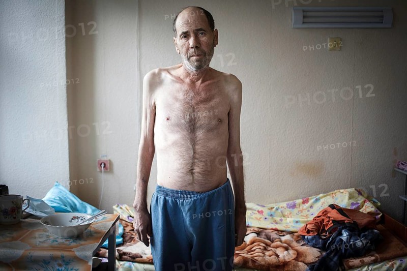 Tuberculosis and HIV in Moldova