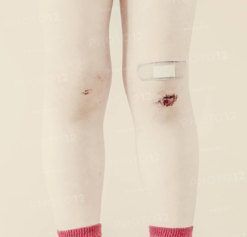 Child's legs with bruises and band-aid