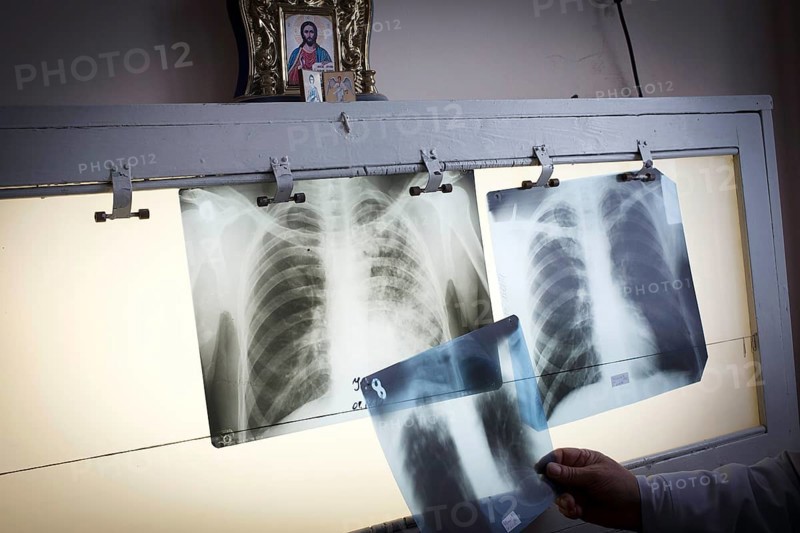 Tuberculosis and HIV in Moldova