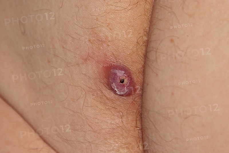 Advanced boil or furuncle on a person's left buttock