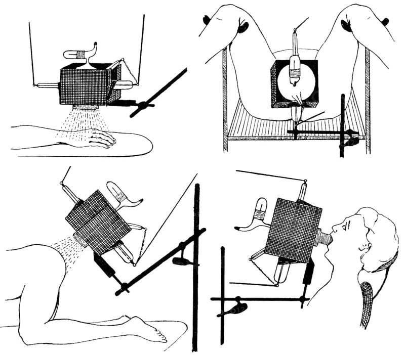 Irradiation of the hand