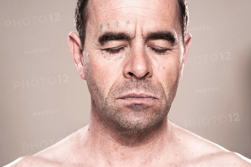 Man with markings for plastic surgery on his face
