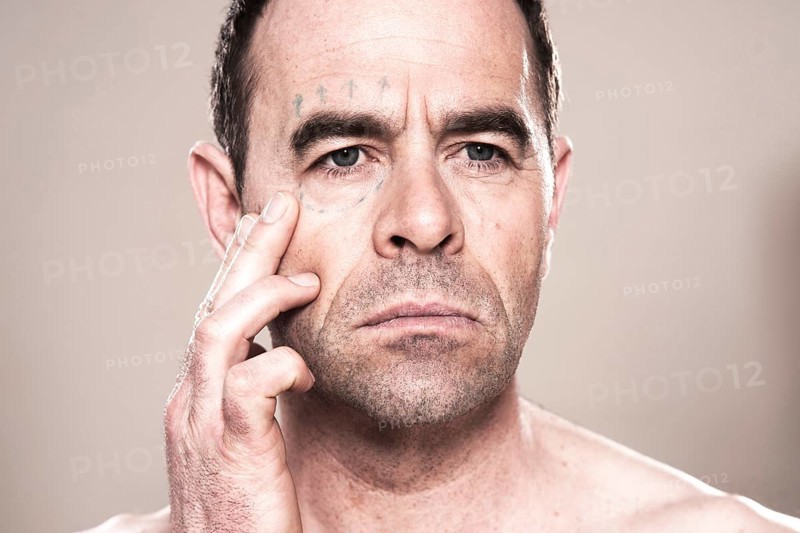 Man with markings for plastic surgery on his face