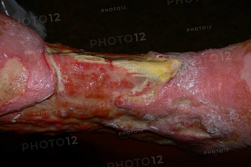 Smoker's leg"" with Squamous-cell carcinoma of the lower leg