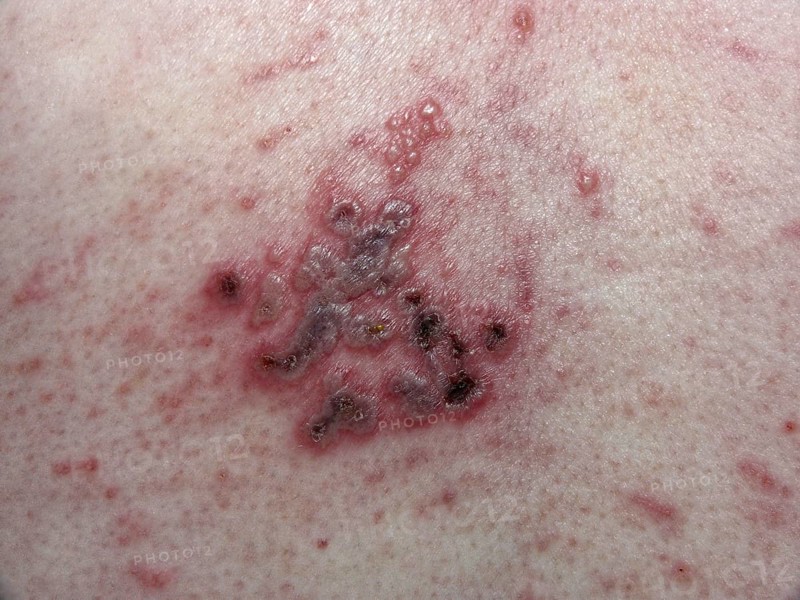 Herpes Zoster on the back