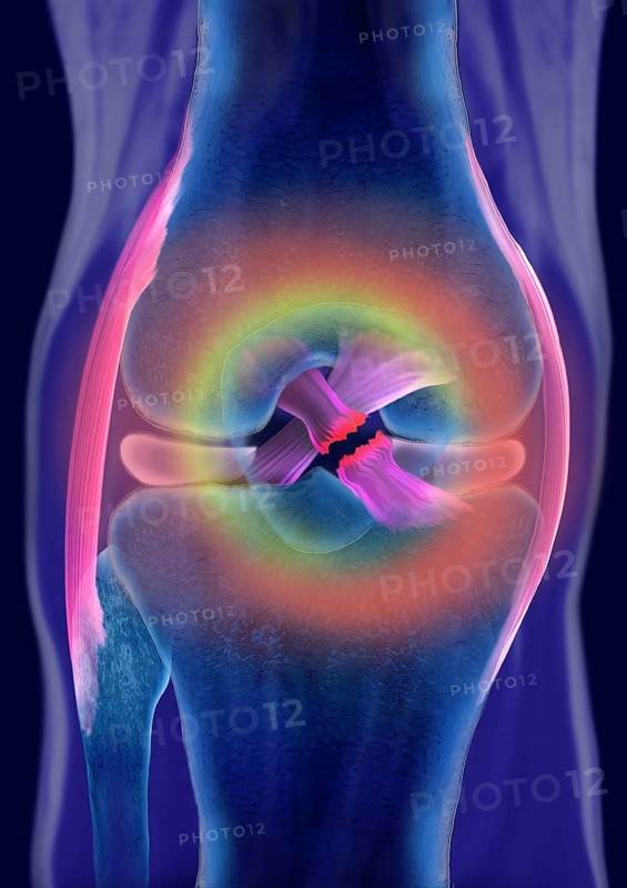 Rupture of a cruciate ligament
