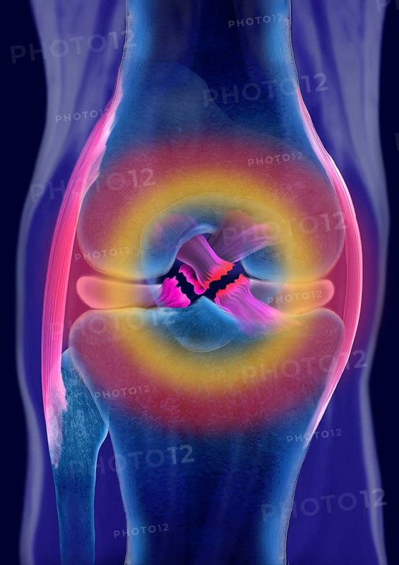 Rupture of both cruciate ligaments