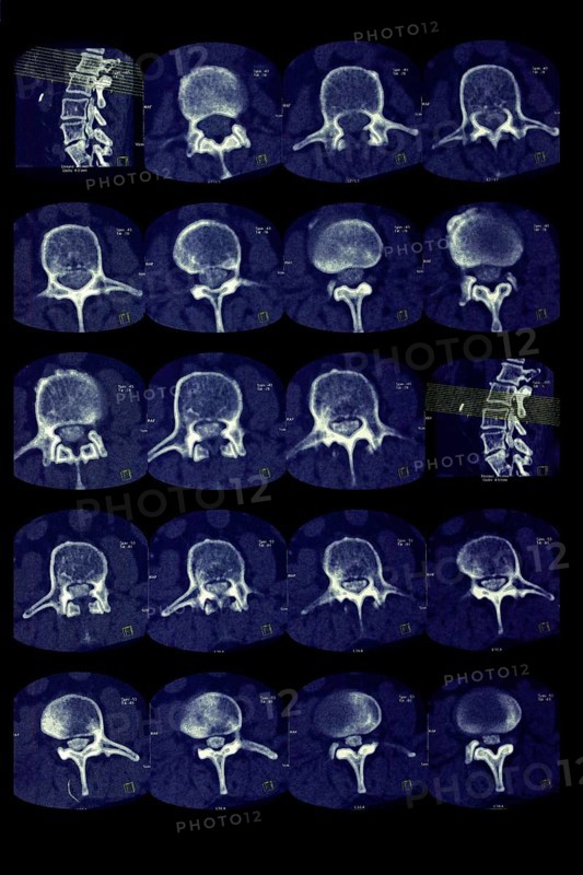 Lumbar vertebrae
