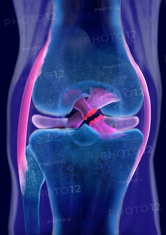 Rupture of a cruciate ligament