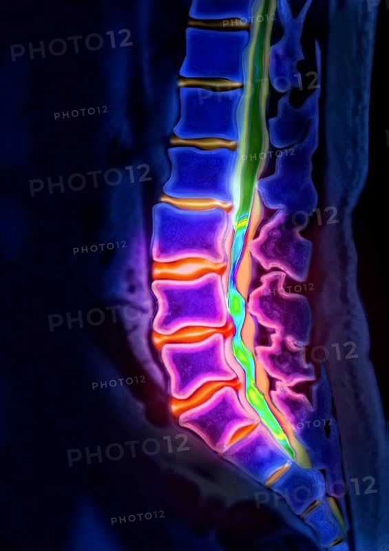 Herniated disk