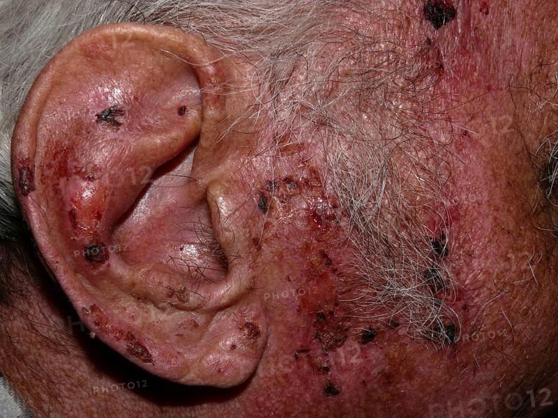 Squamous-cell carcinomas of the face and ear