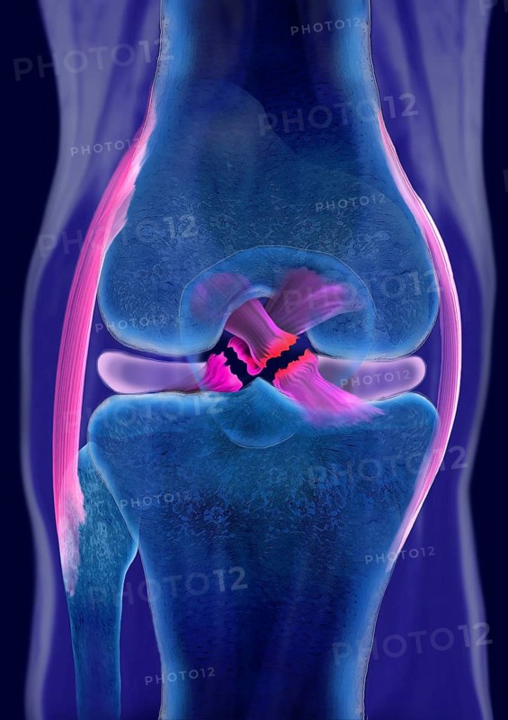Rupture of both cruciate ligaments