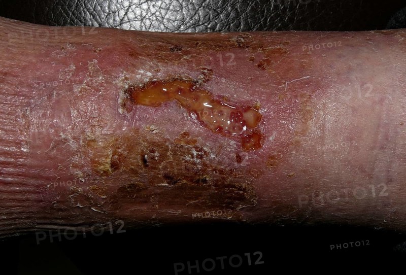 Infected bite wound of the lower leg