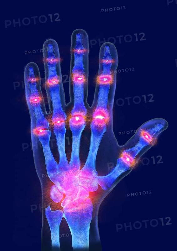 Hand of a person suffering from gout