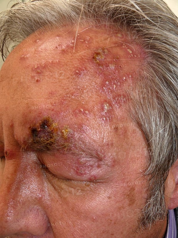 Herpes zoster ophthalmicus