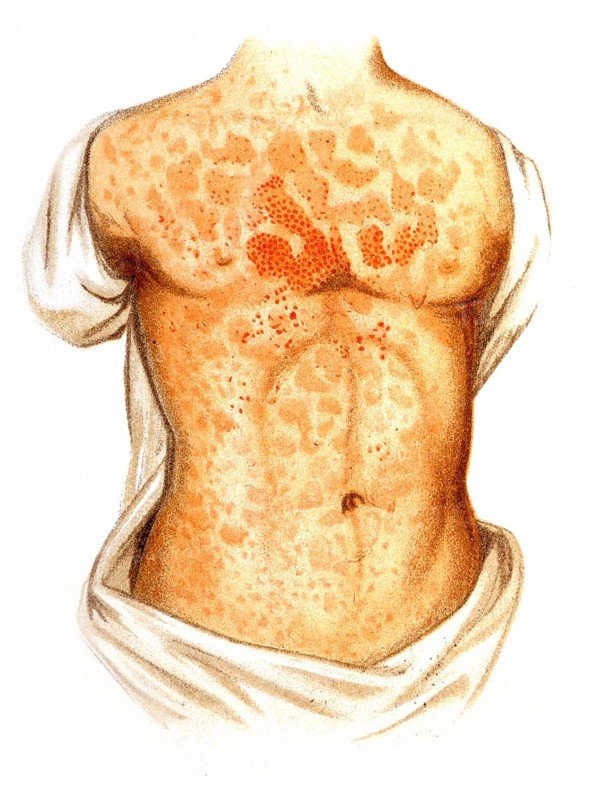 Measles