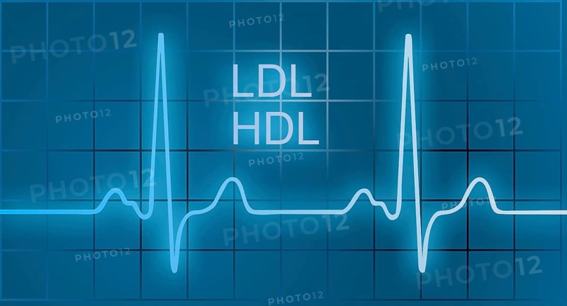 ECG